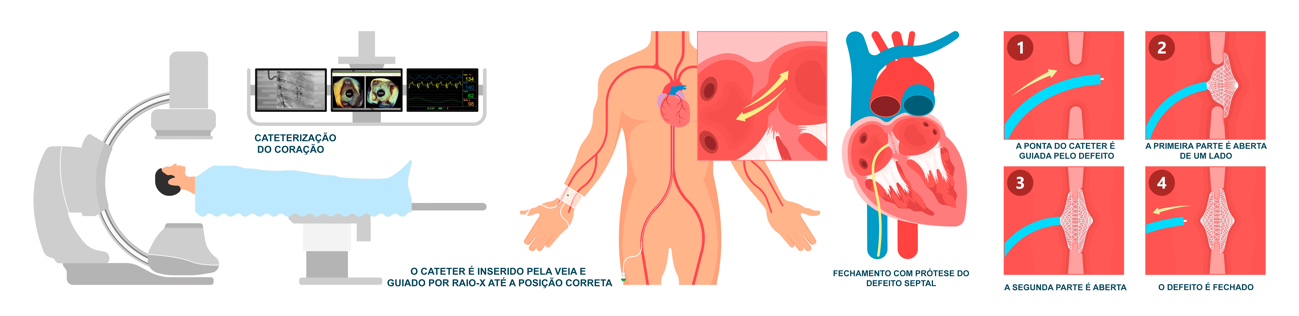 Diagrama ilustrando um procedimento médico: Um paciente deita-se em uma mesa sob uma máquina de raio X enquanto monitora a anatomia do coração.
