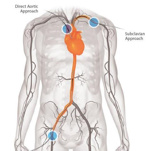 Diagrama do sistema circulatório humano, destacando a aorta e possíveis pontos de acesso ao cateter: abordagens aórtica e subclávia diretas.
