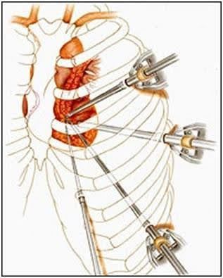 Diagrama ilustrando uma cirurgia minimamente invasiva na cavidade torácica, com instrumentos cirúrgicos inseridos através de pequenas incisões.