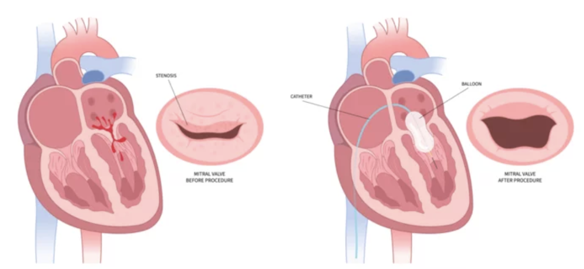 Diagrama ilustrando a válvula mitral em um coração saudável (esquerda) versus um coração com estenose (direita). A válvula estenótica está constrita e calcificada.