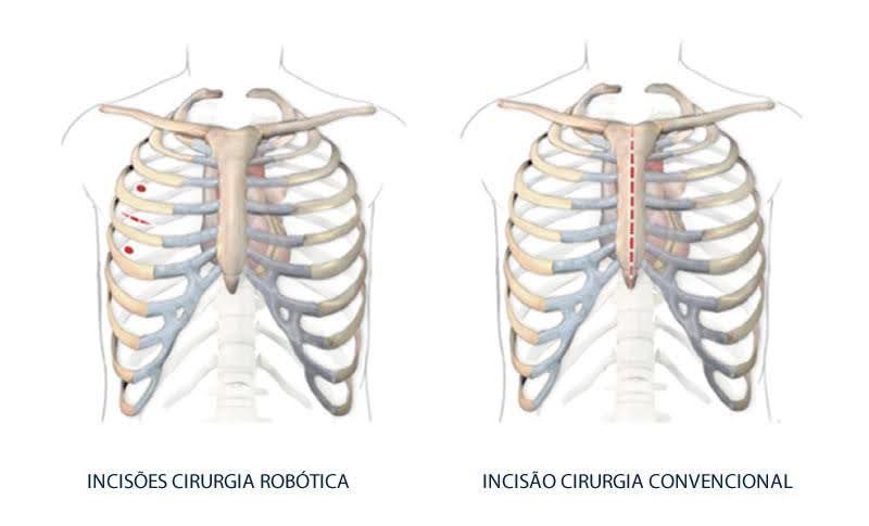 Diagrama comparando incisões em cirurgia robótica (esquerda, pequenos pontos vermelhos) e cirurgia convencional (direita, longa incisão na linha média) em uma caixa torácica.