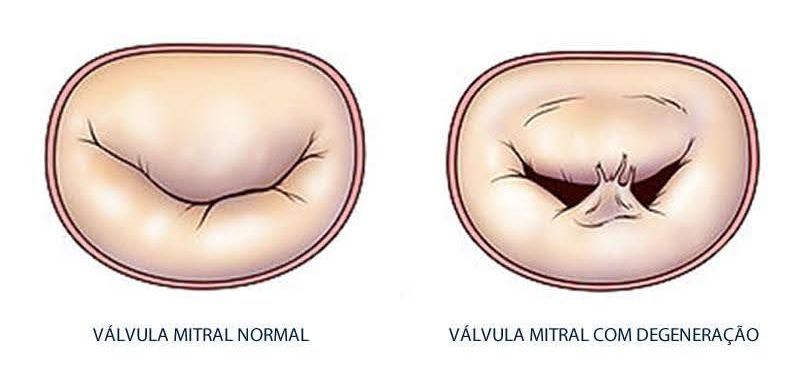 Ilustração comparando uma válvula mitral normal (esquerda) com uma degenerada (direita), mostrando a diferença no formato.
