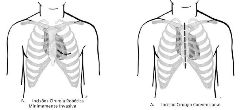 Diagrama comparando dois tipos de incisão cirúrgica no tórax humano. A esquerda mostra a incisão minimamente invasiva, a direita mostra a incisão convencional.