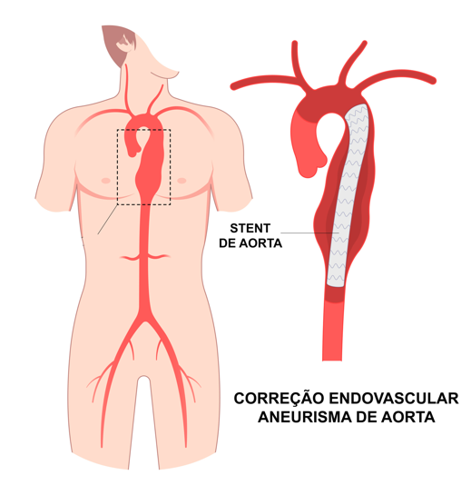 Diagrama ilustrando um reparo endovascular de aneurisma aórtico usando um stent. Uma aorta vermelha é mostrada dentro de uma figura humana, com uma visão detalhada do stent.