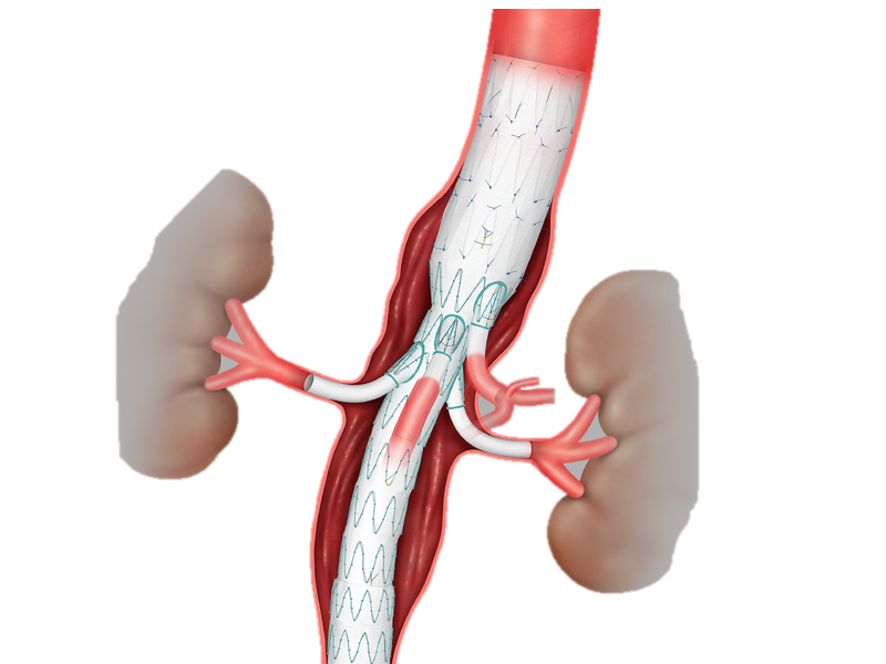 Ilustração de um enxerto de stent aórtico, mostrando um tubo de malha colocado dentro da aorta e vasos ramificados para os rins.