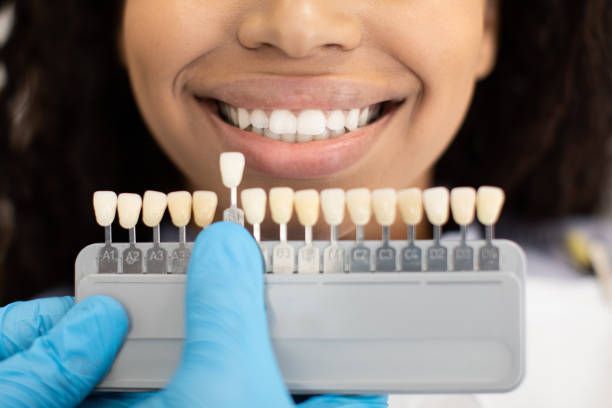 Porcelain & Composite Veneers — Belmont, VIC — Geelong Dental Group