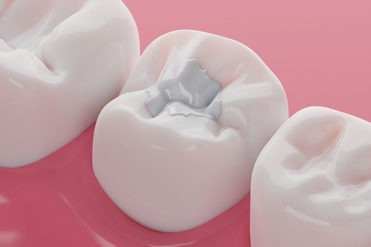 Fillings — Belmont, VIC — Geelong Dental Group