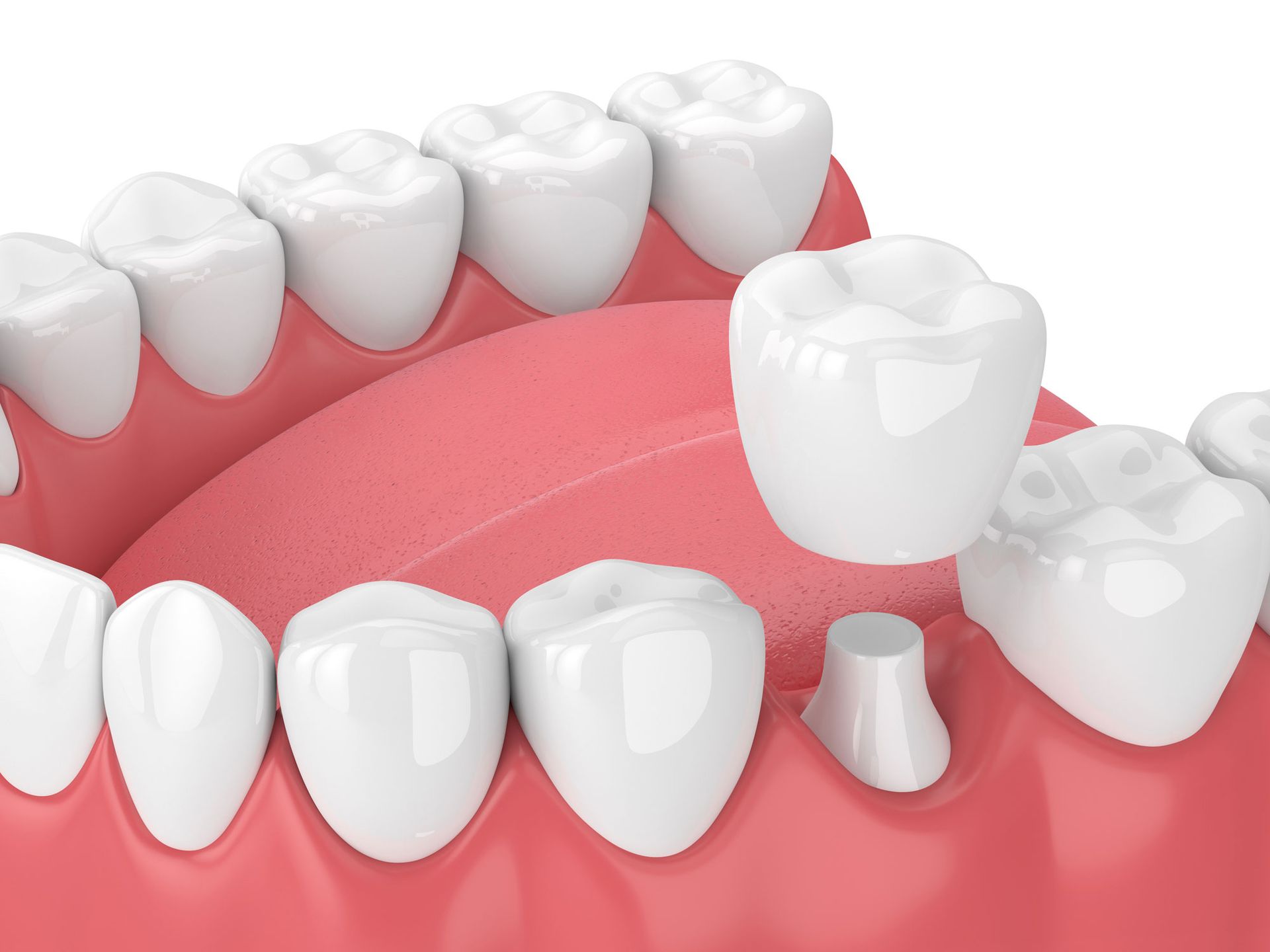 Crowns — Belmont, VIC — Geelong Dental Group