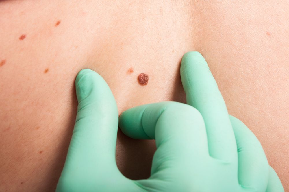 Gloved Hands Examining a Small Mole on a Person’s Bare Back — HealthHub Taree in Taree, NSW