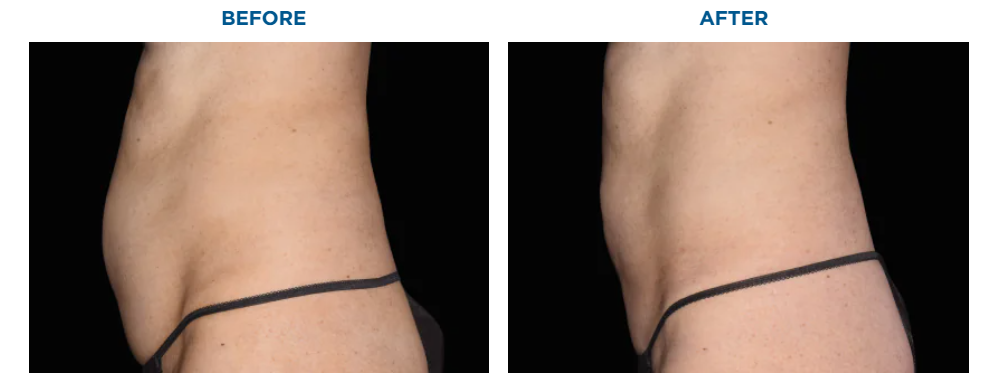Side-by-side comparison of a person's abdomen, labeled 