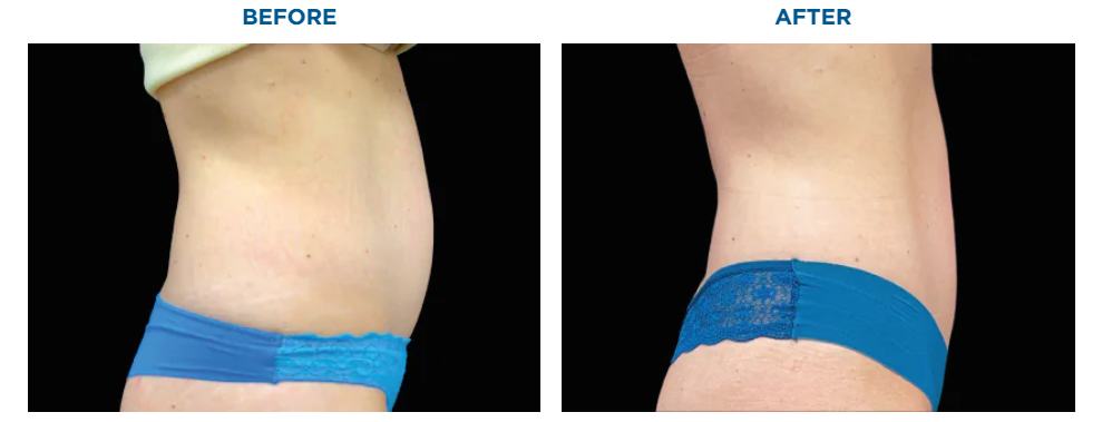 Side-by-side comparison of a person's abdomen before and after a procedure, showing fat reduction.