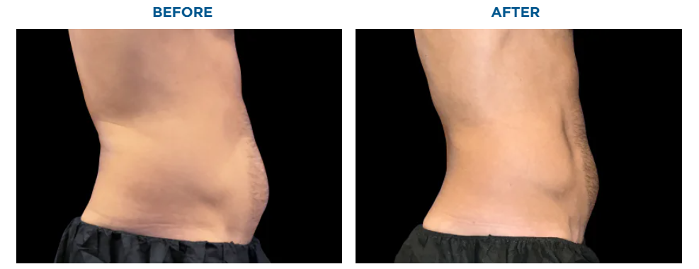Side-by-side comparison of a person's abdomen, labeled 
