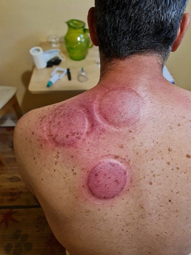 גב של גבר עם כוסות כוסות רוח עליו.