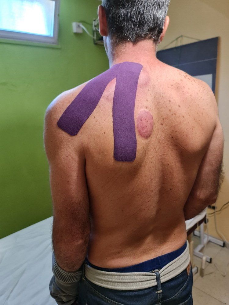 גבר עם קינזיוטייפ סגול על גבו