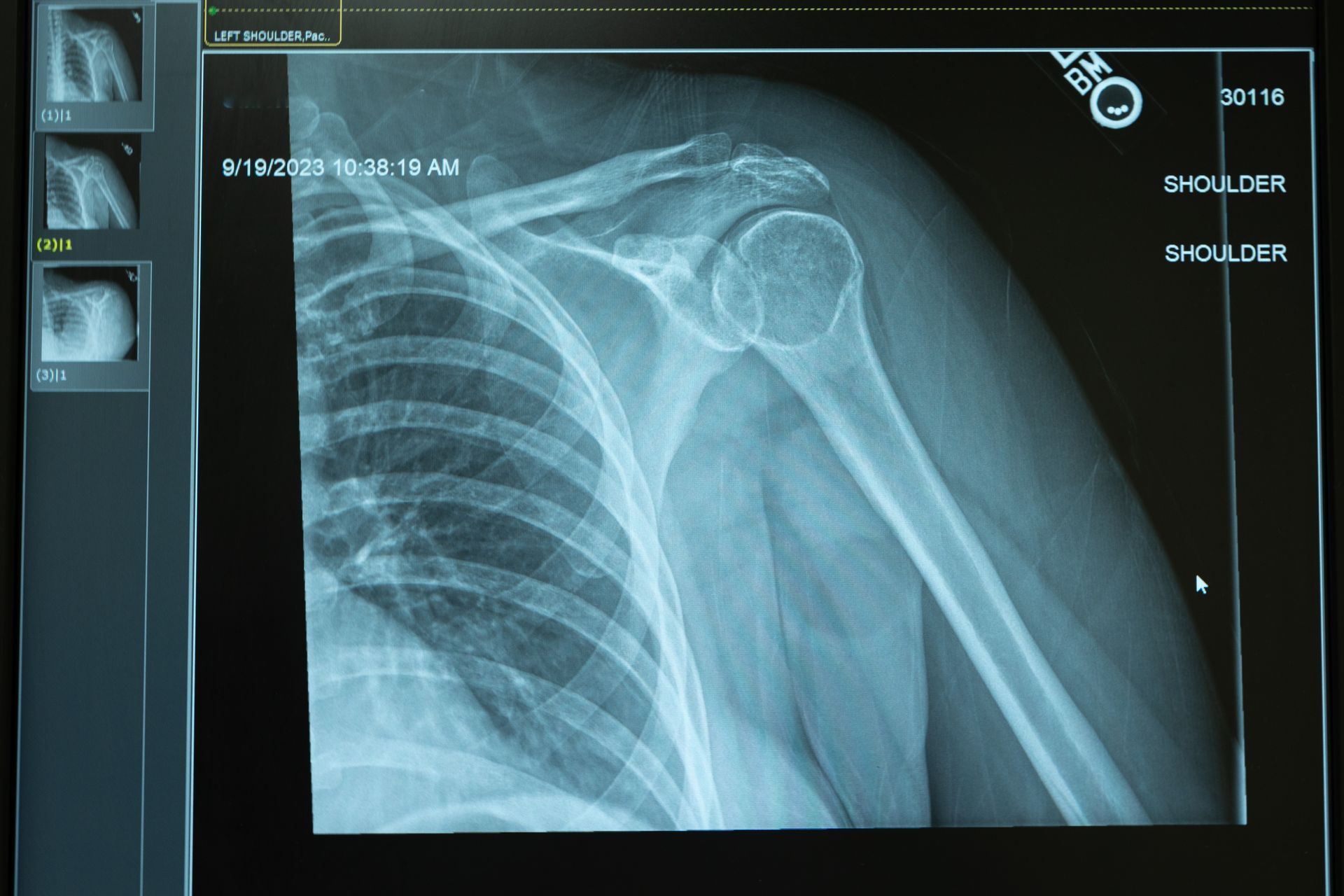 An x-ray of a person 's shoulder and chest