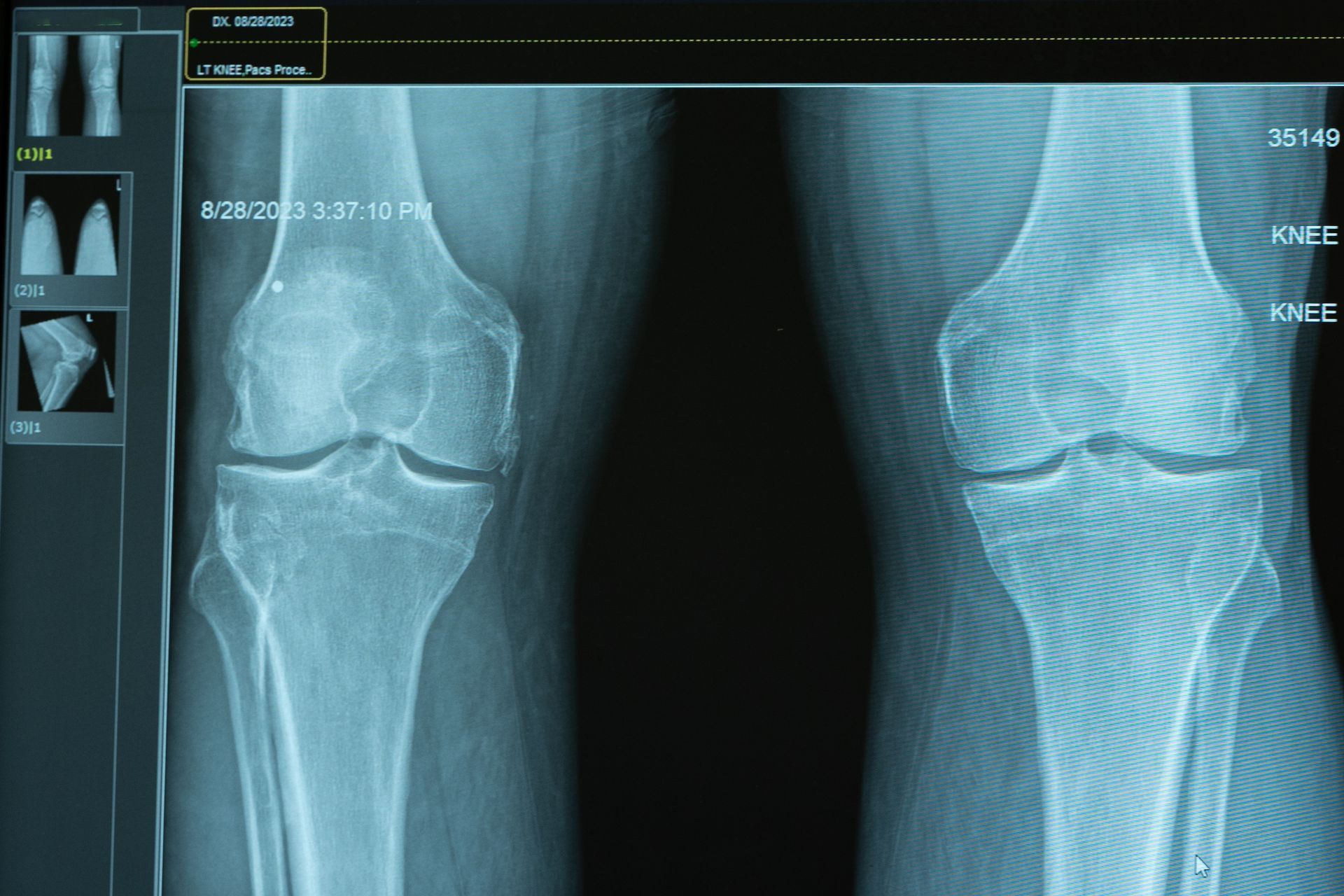 An x-ray of a person 's knee and leg