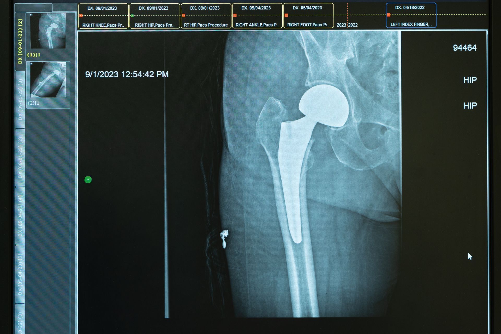 A computer screen shows an x-ray of a hip joint