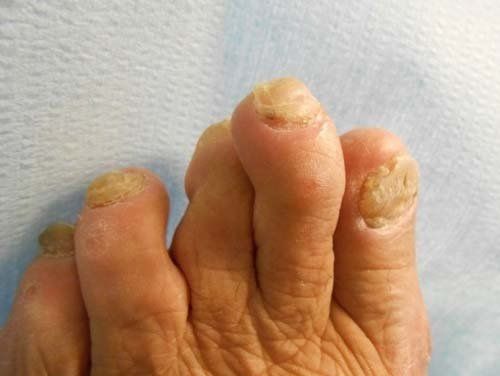 Dita dei piedi