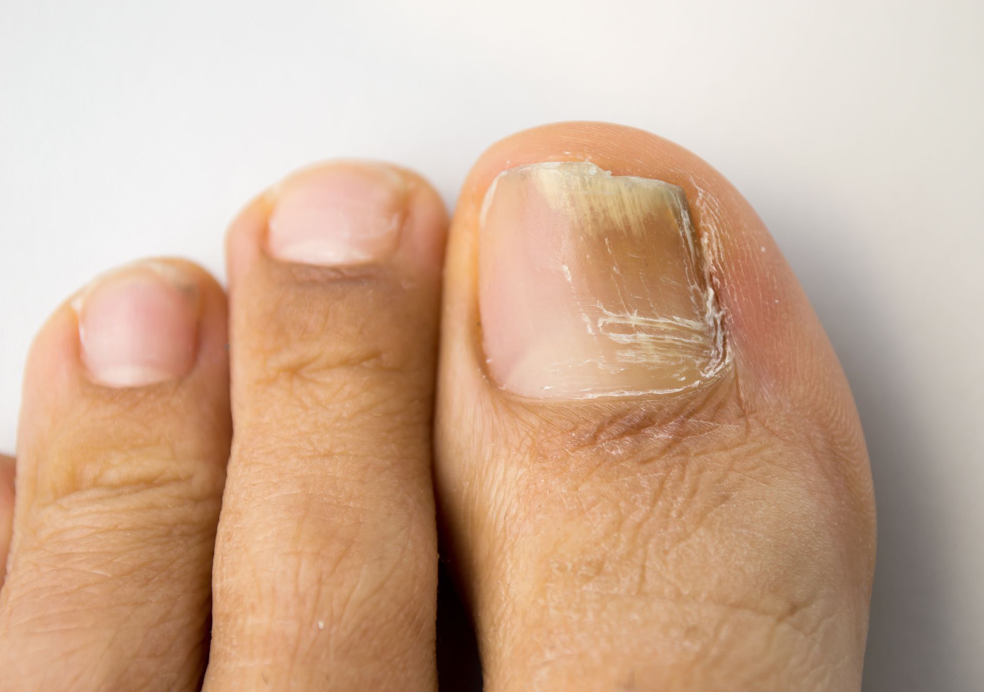 NAGELPILZ, Hautarzt Dr.med.univ. Michael Skoll, 1110 Wien