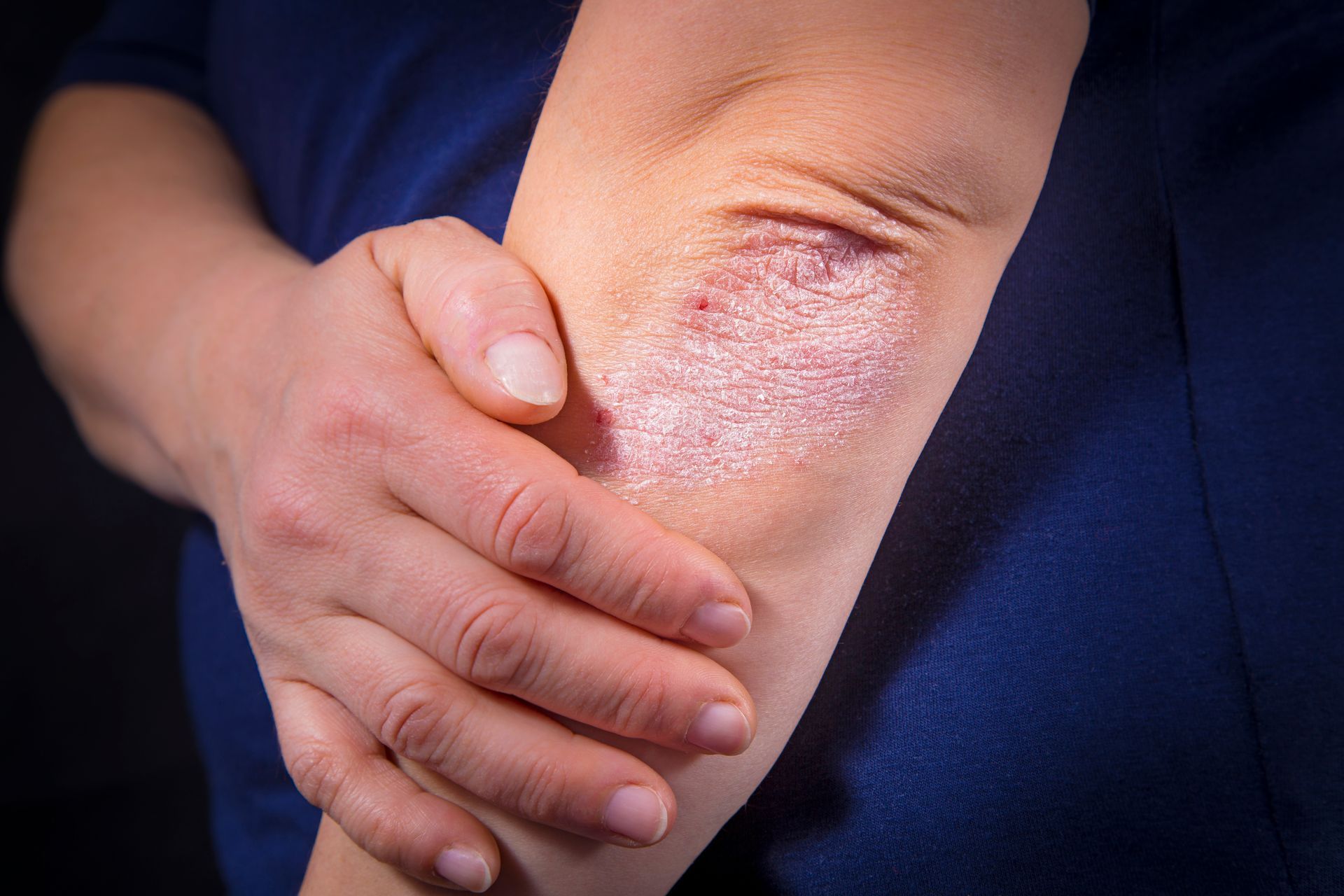 Schuppenflechte (Psoriasis), Hautarzt Dr.med.univ. Michael Skoll