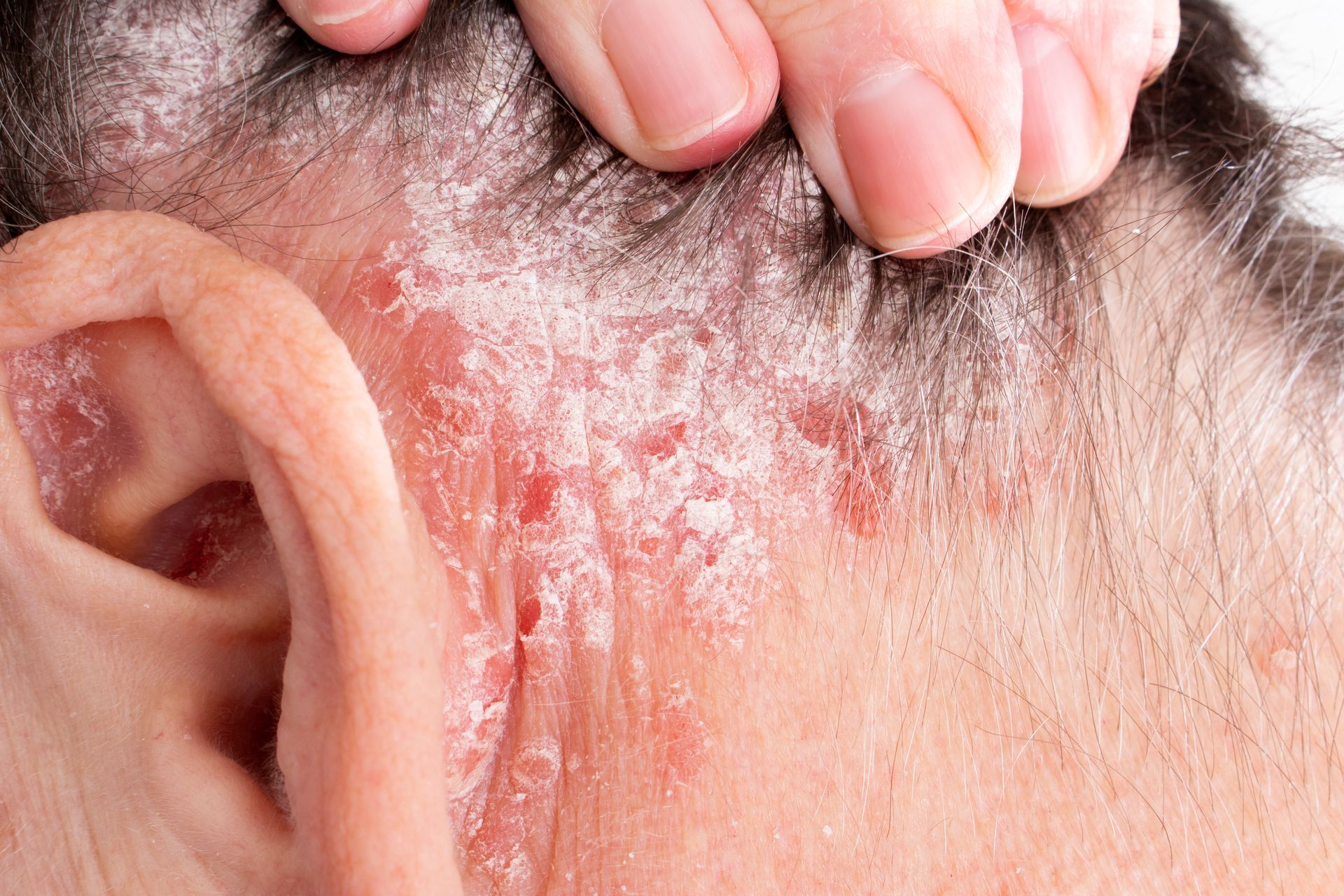 SCHUPPENFLECHTE (PSORIASIS), Hautarzt Dr.med.univ. Michael Skoll, 1110 Wien
