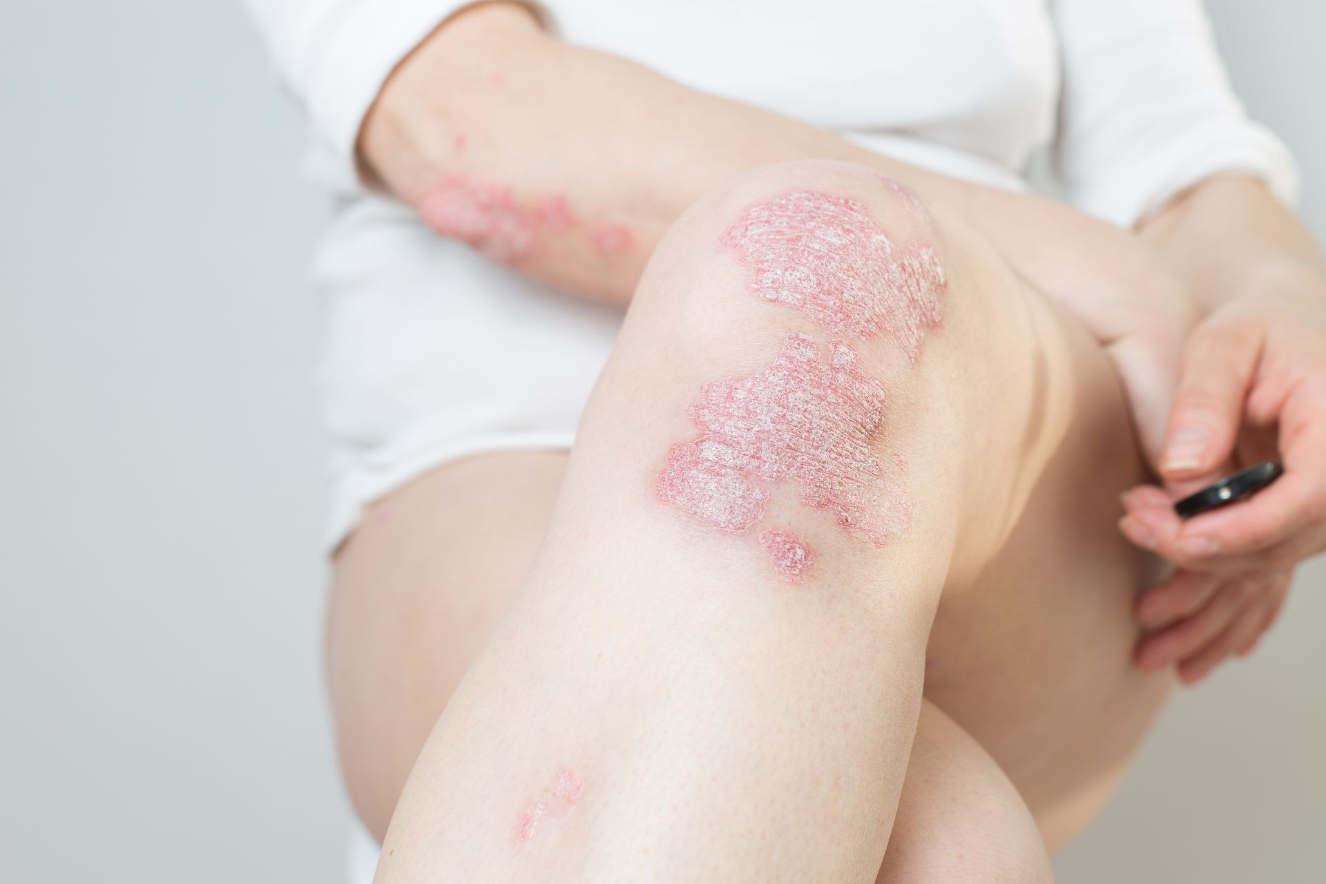 Schuppenflechte (Psoriasis), Hautarzt Dr.med.univ. Michael Skoll