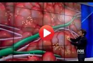 Ultrasound Cavitation as Seen on Dr. Oz