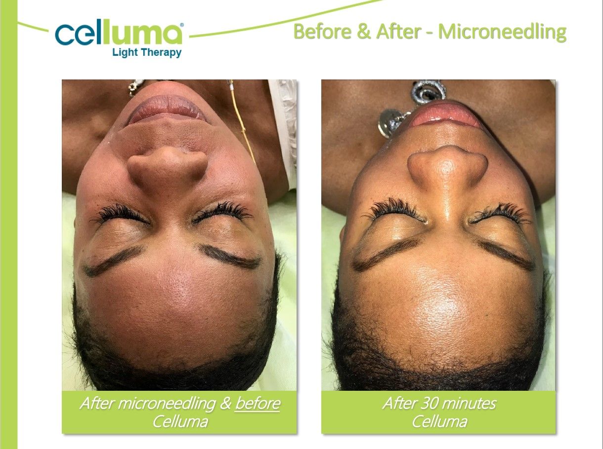 Two pictures of a woman 's face before and after microneedling