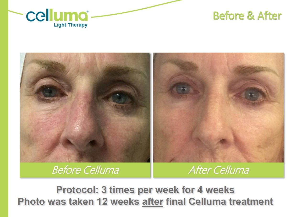 A before and after photo of a woman 's face
