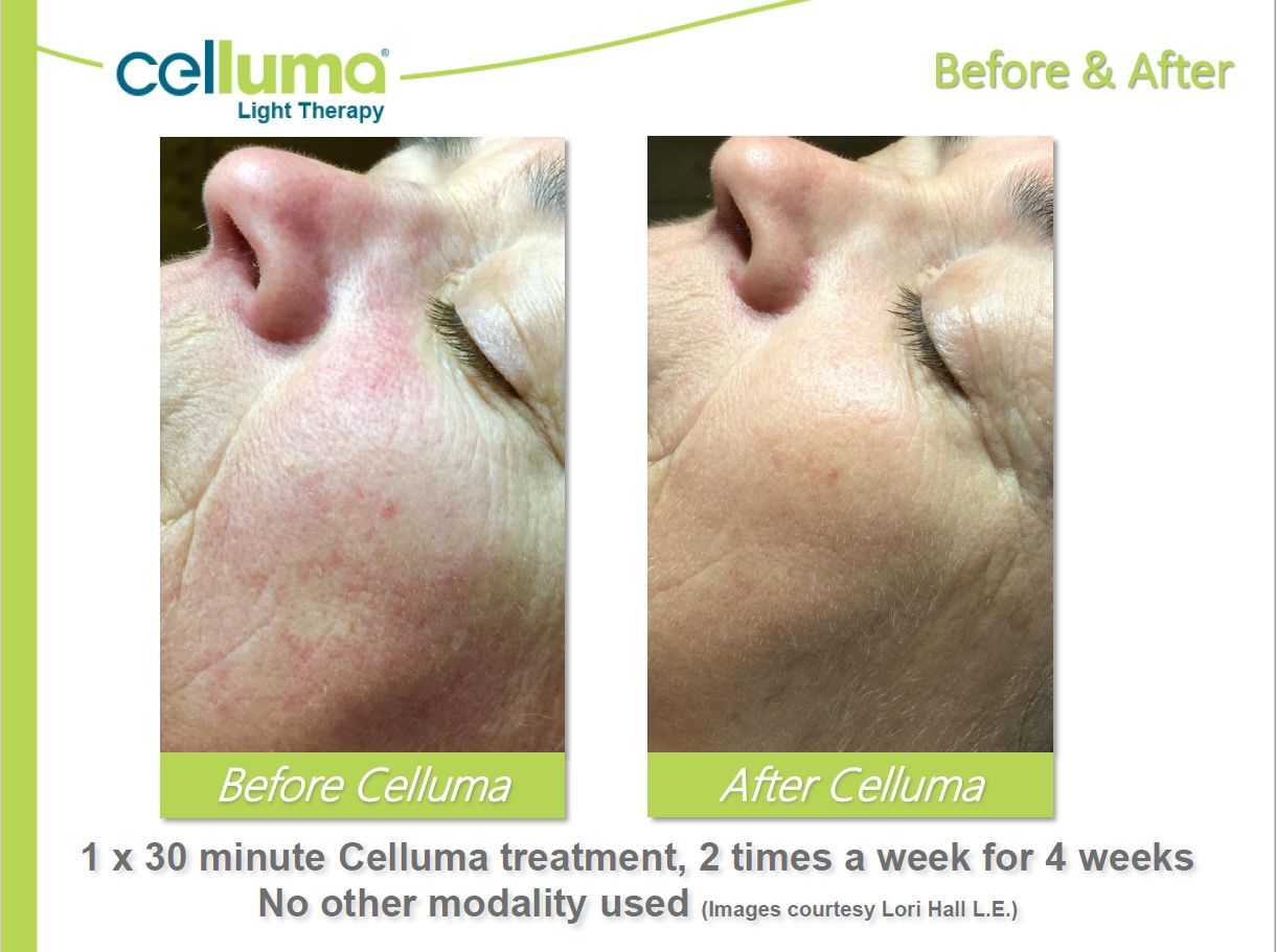 A before and after photo of a woman 's face