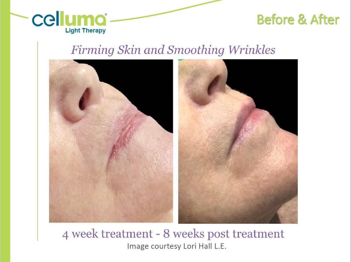 A picture of a woman 's face before and after a celluma treatment