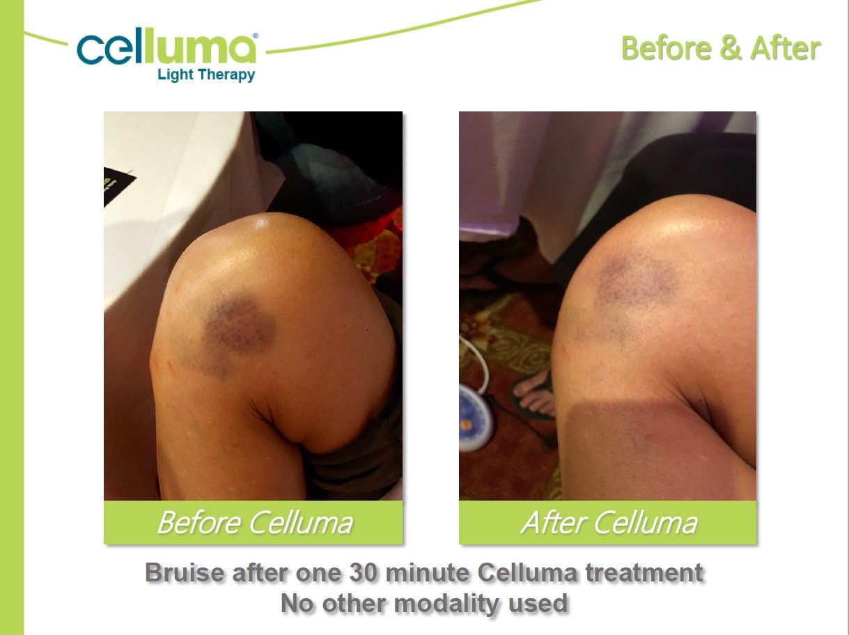 Knee scar treatment