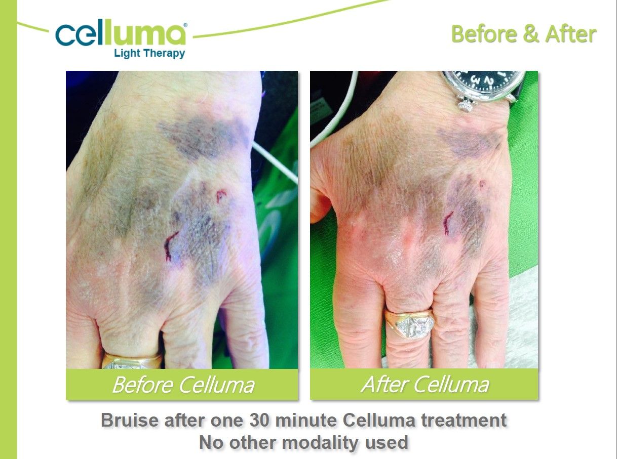 A before and after picture of a person 's hand