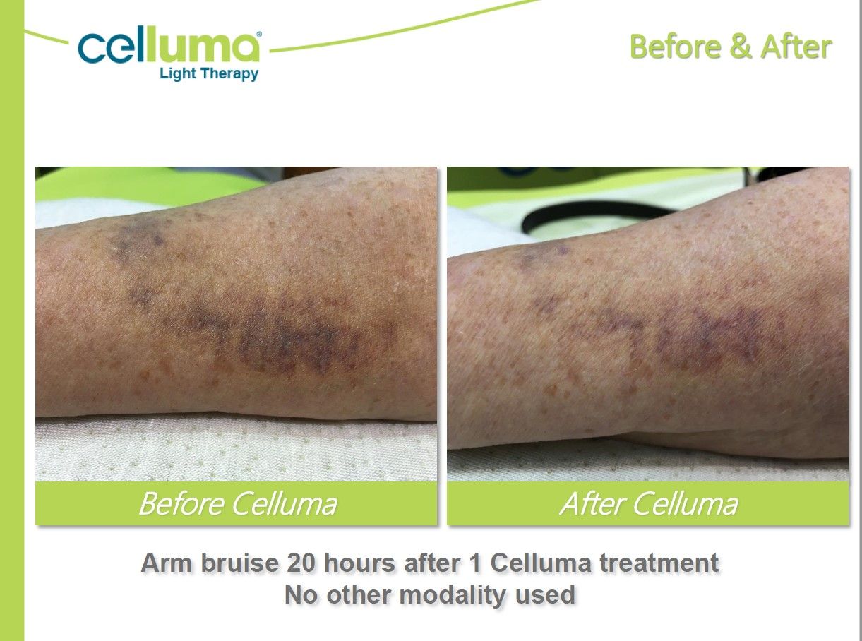 A picture of a person 's arm before and after celluma treatment