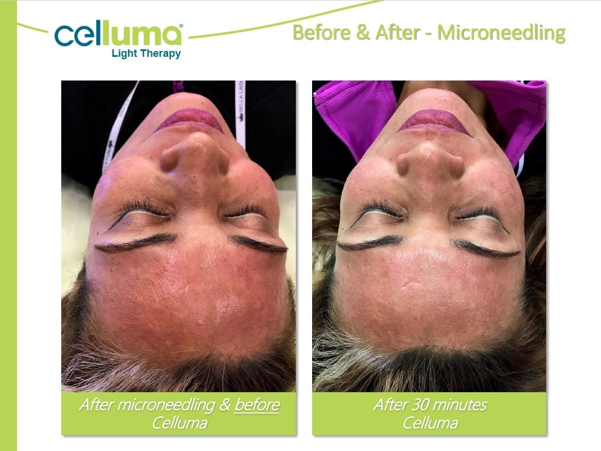 A woman 's face is shown before and after microneedling