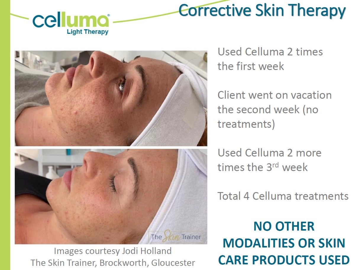 A before and after photo of a woman getting corrective skin therapy