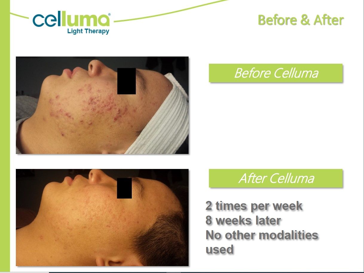 Before and after celluma