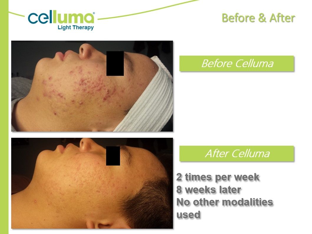 A picture of before and after celluma