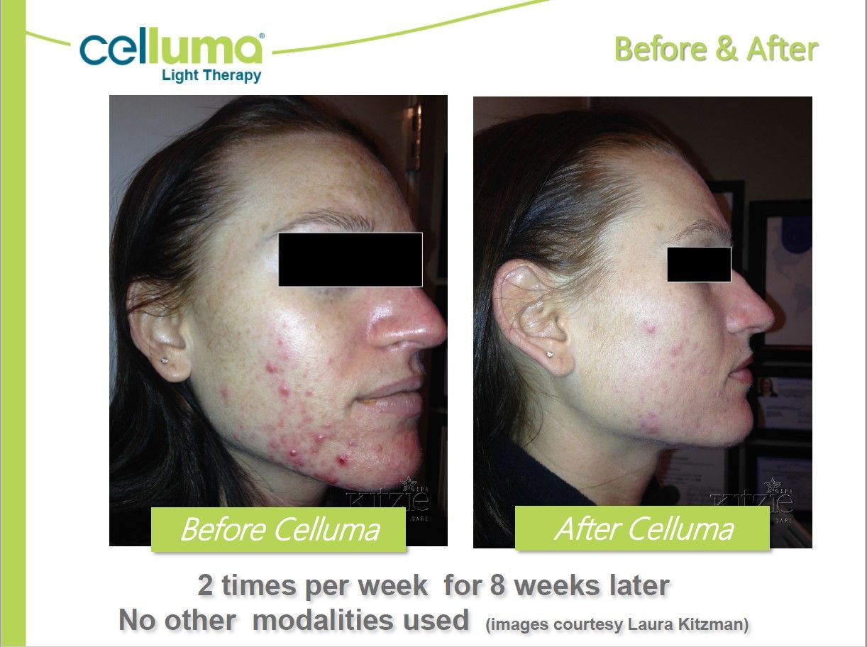A before and after photo of a woman 's face