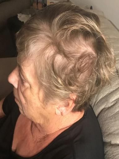 A woman with a bald spot on her head is sitting on a couch