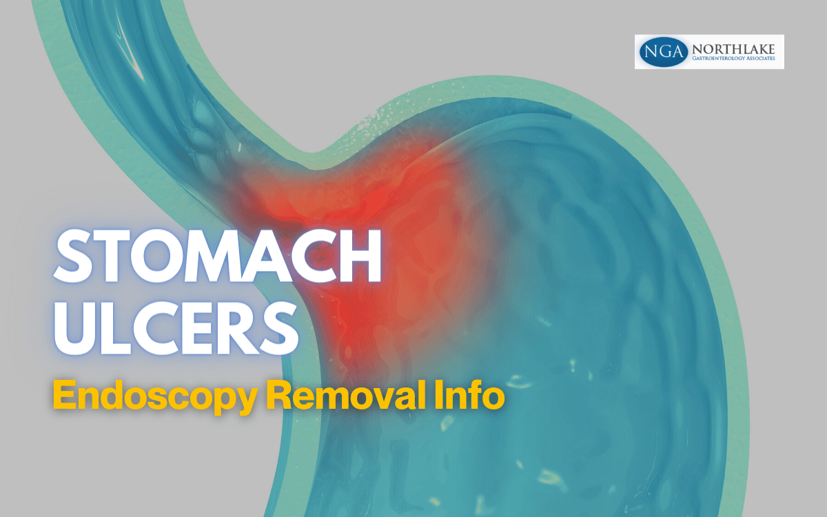 Illustration of stomach with stomach ulcer