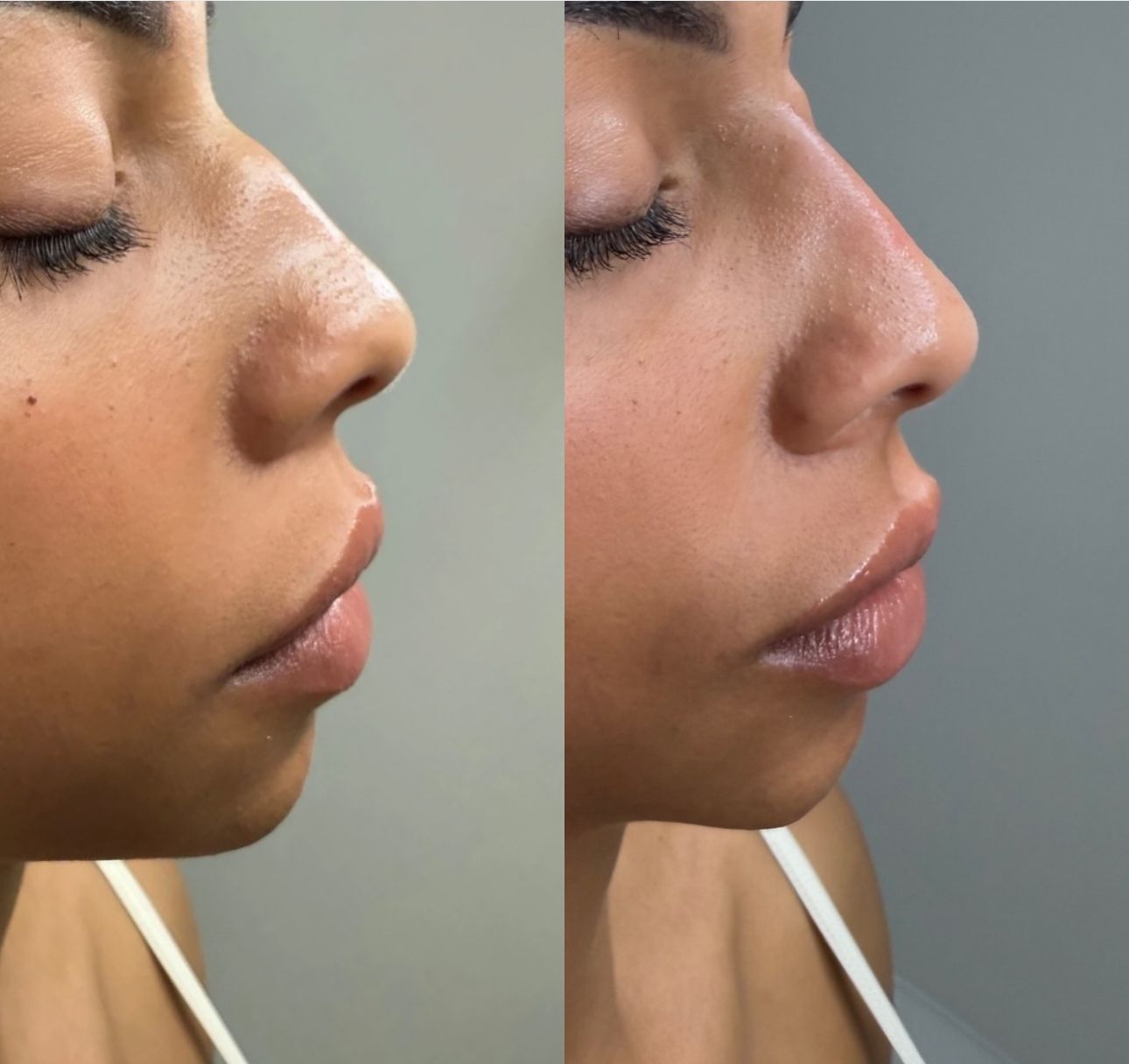 A before and after photo of a woman 's nose.