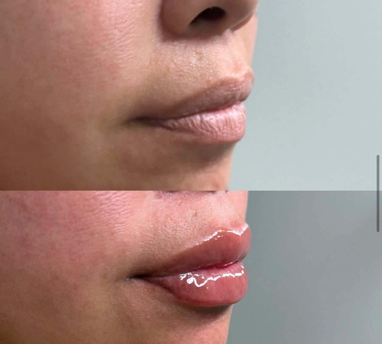 A before and after photo of a woman 's lips.