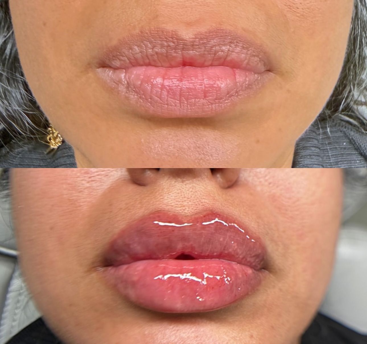 A before and after photo of a woman 's lips.