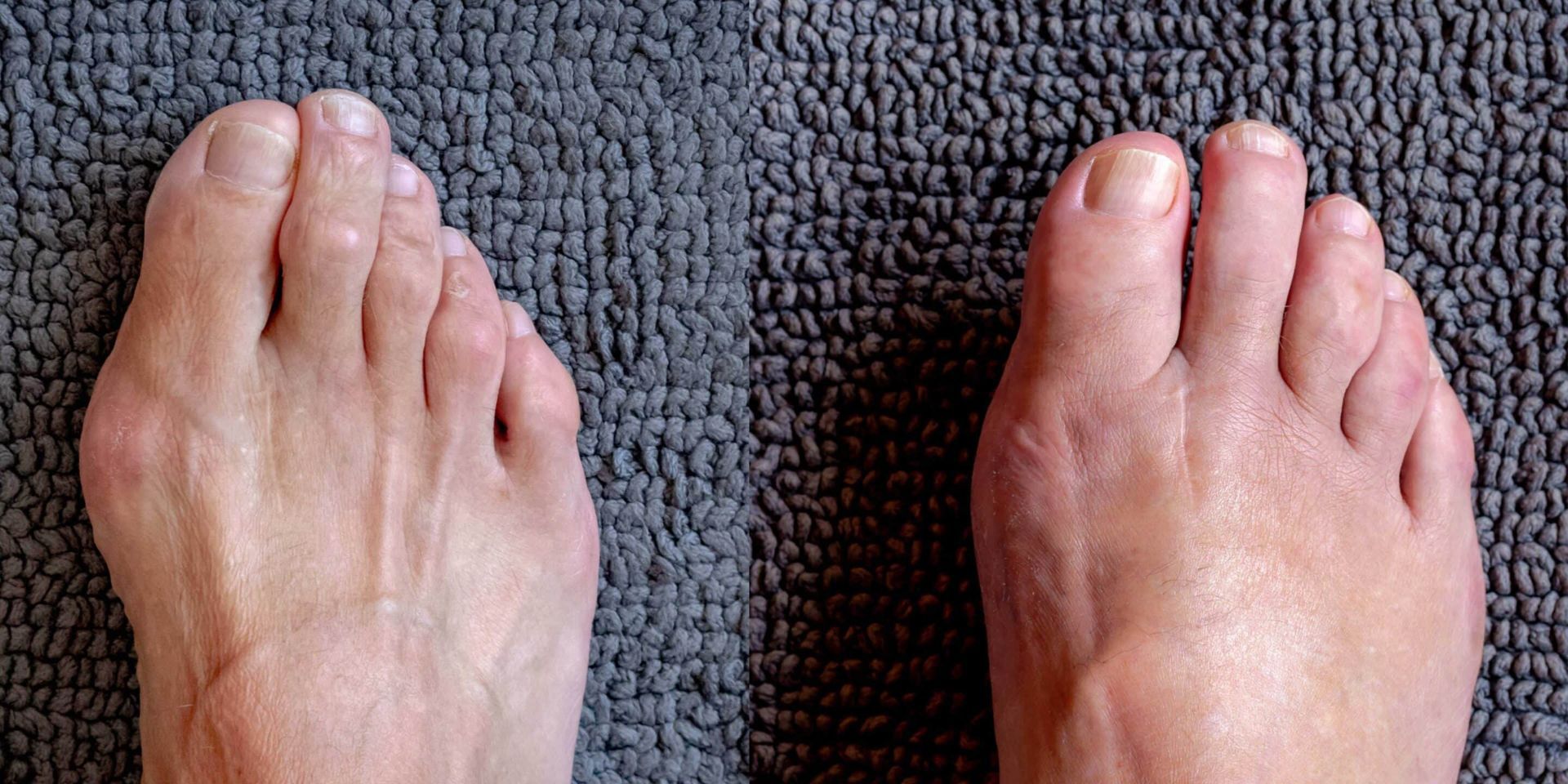Two bare feet, side-by-side, on a textured gray surface. The feet have visible toes and skin texture.