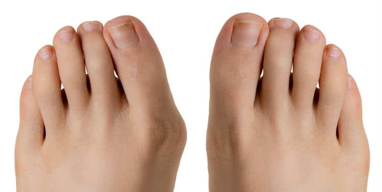 Pair of bare feet, one with a bunion on the big toe.