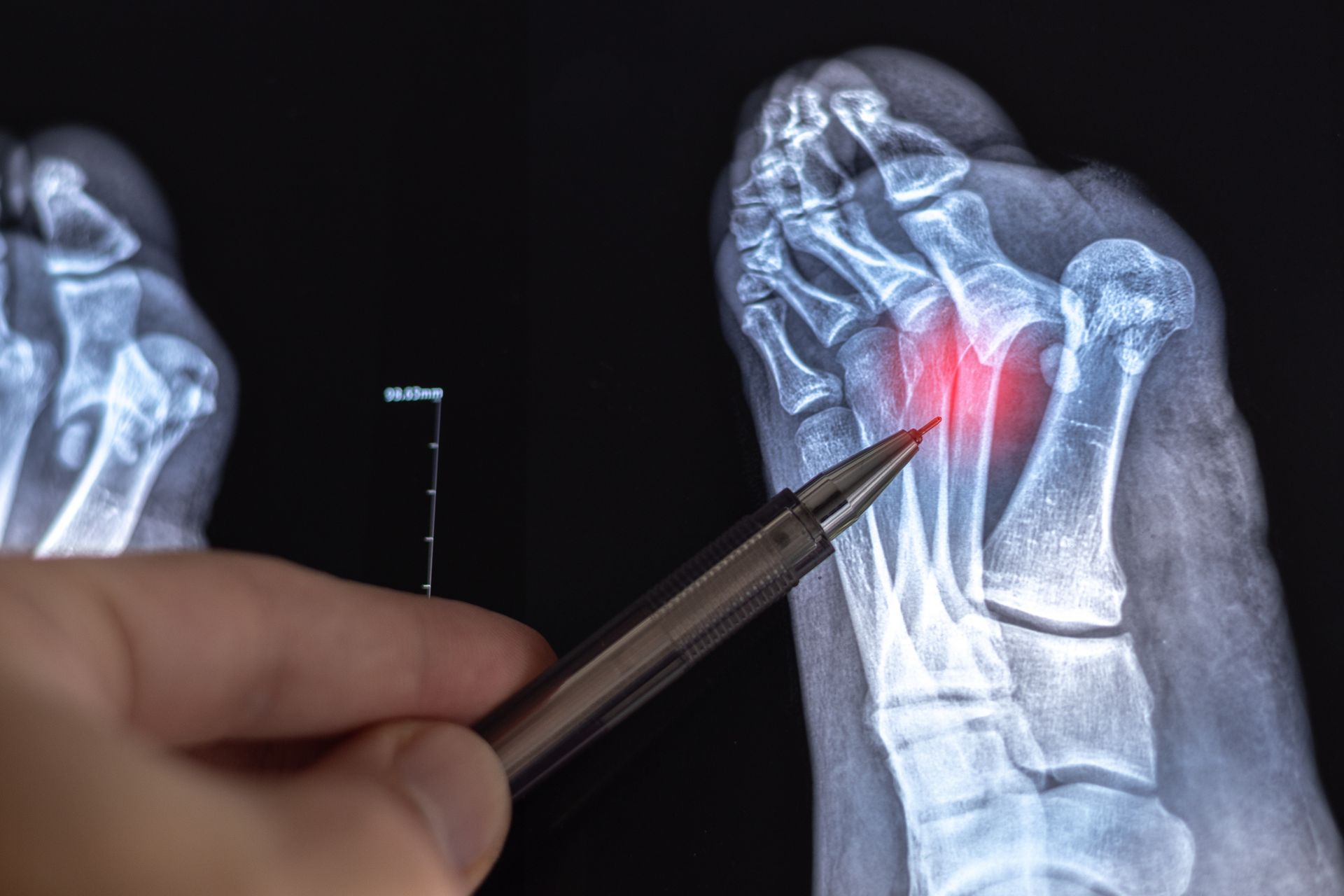 X-ray of foot with red highlighting a bone, a hand pointing with a pen.