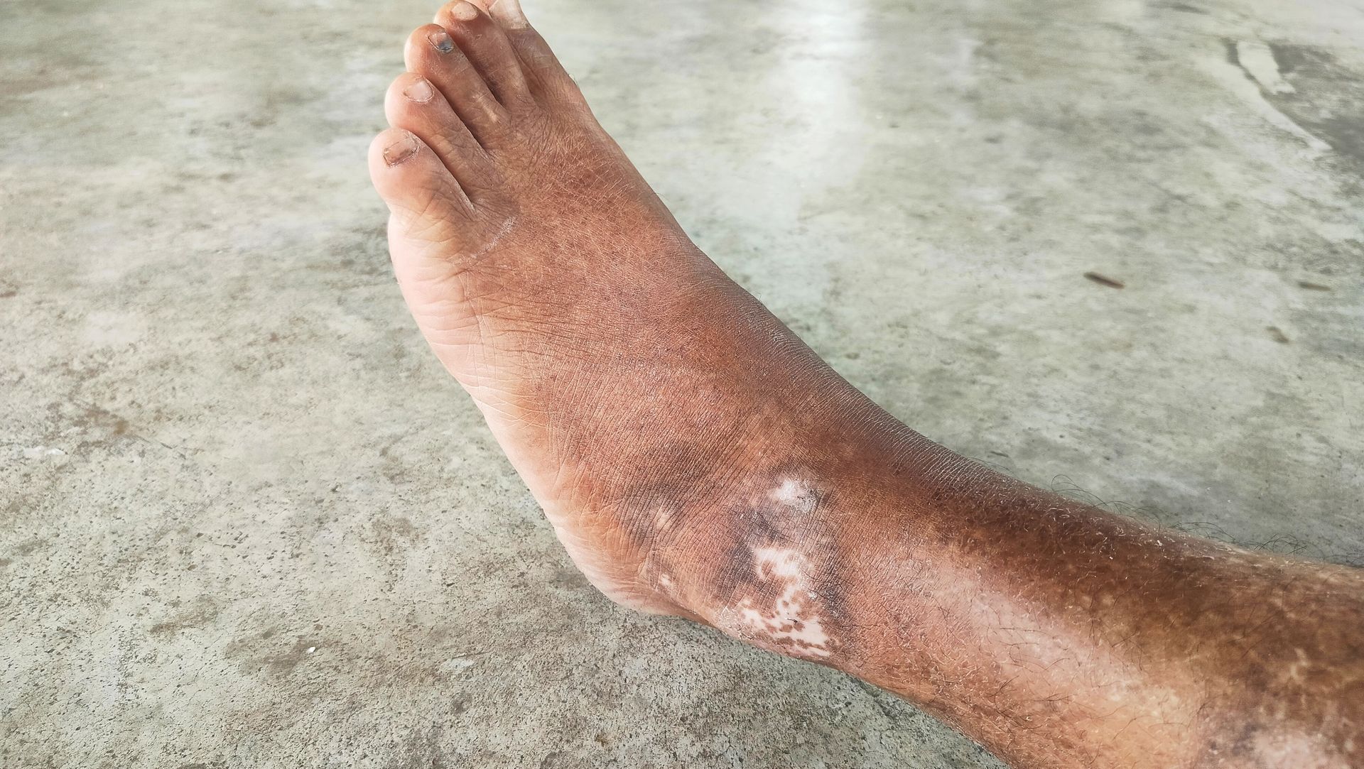 Foot with patches of discolored skin on a cement surface.