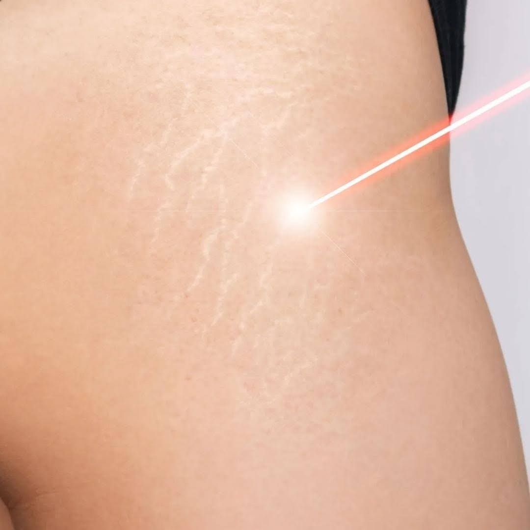 Professional skin resurfacing treatment using CO2 laser technology to reduce acne scars and stretch marks
