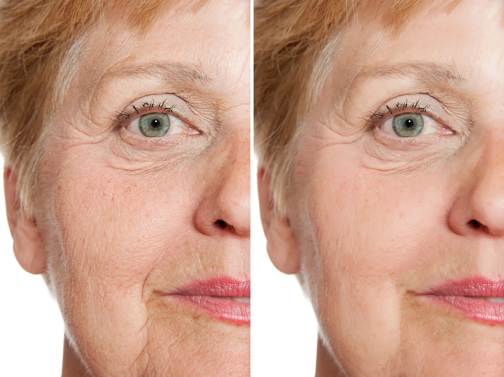 Advanced laser skin resurfacing treatment improving skin texture and tone